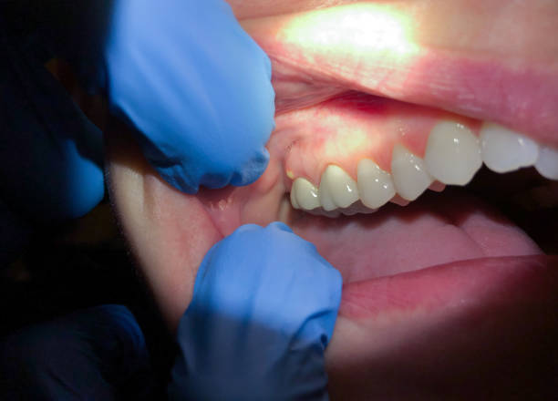 Best Teeth Whitening  in Wallace, FL